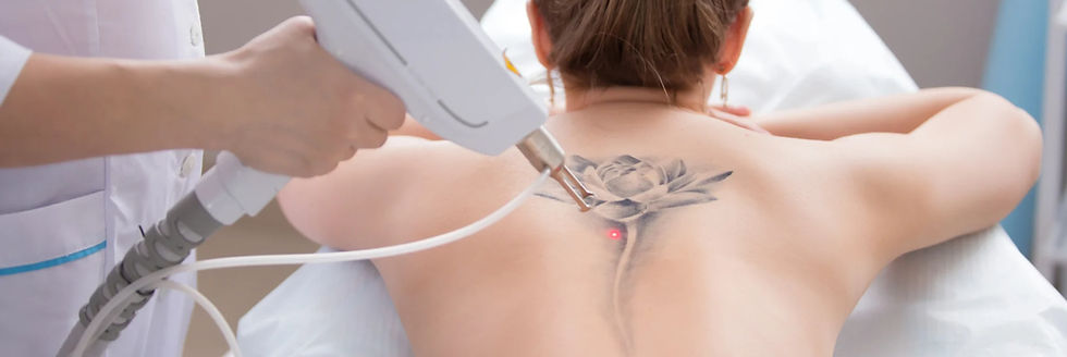 Tattoo-Removal Simetics_edited.jpg