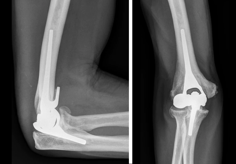 total-elbow-replacement.webp