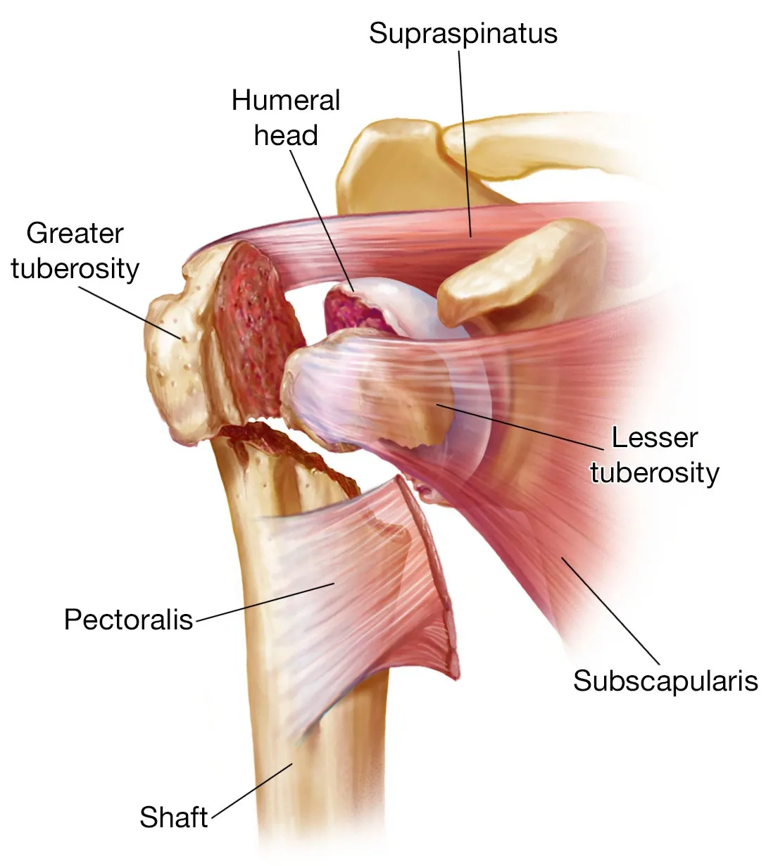 the-proximal-humerus-may-fracture-in-multiple-parts.webp