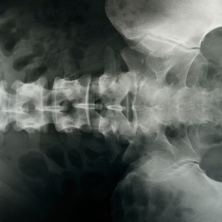 X-ray image of a human spine in grayscale, showing vertebrae structure. No visible text or additional objects present.