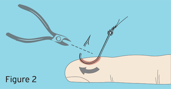 push-barb-throught-skin-illustration.gif