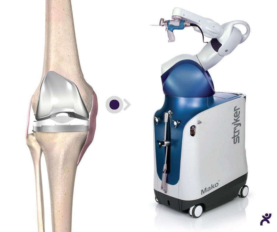 Mako Robotic-Arm Assisted Surgery For Total Knee Replacement