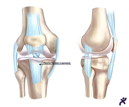 Overview of Patellar Tendonitis: Causes, Treatment, and Recovery