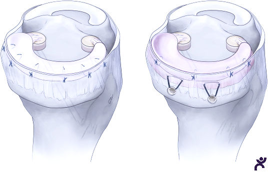 Meniscus Transplant Surgery
