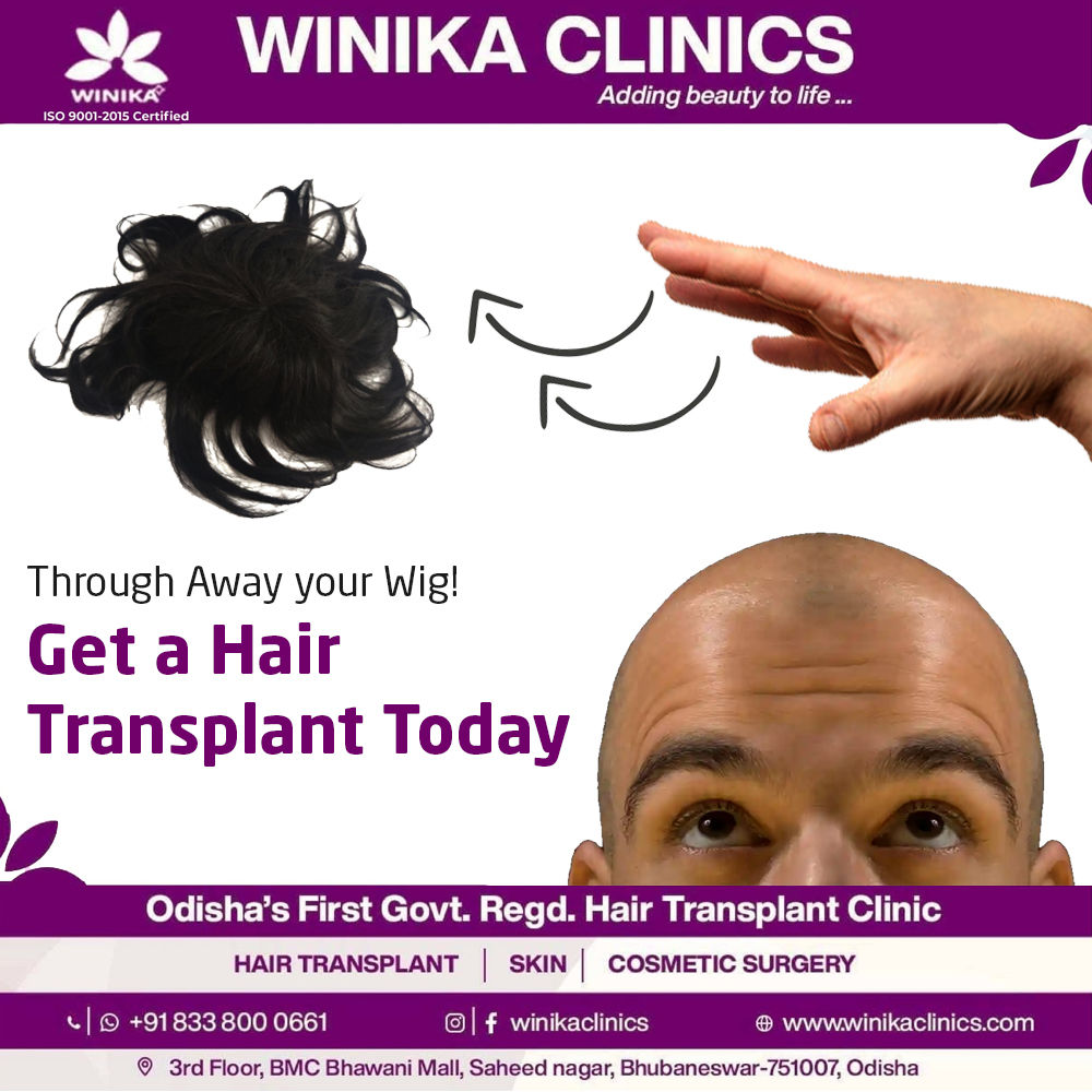 Hair Transplant Vs Wig Which Is More Effective For Hair Loss?