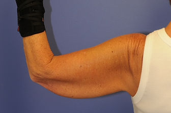 Brachioplasty 01 before 2 of 3.jpg
