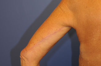 Brachioplasty 01 after 5 of 5.jpg