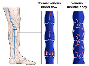 Chronic Venous
