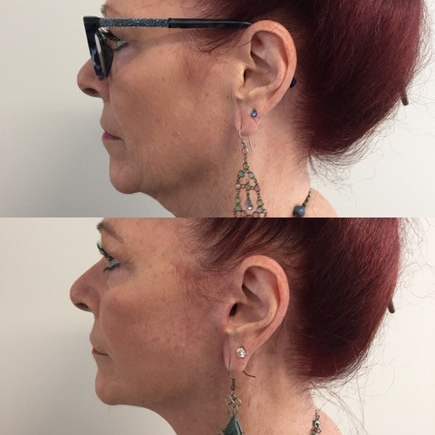 Glenys, before and after at 2 months