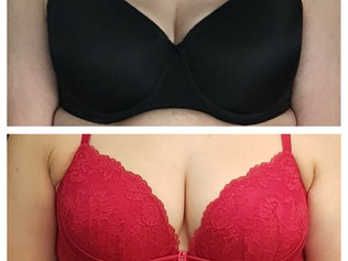 FAT TRANSFER TO THE BREASTS OFFERS NEW POSSIBILITIES