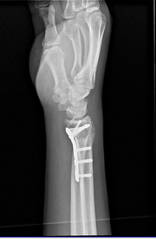 Distalradius lat.JPG
