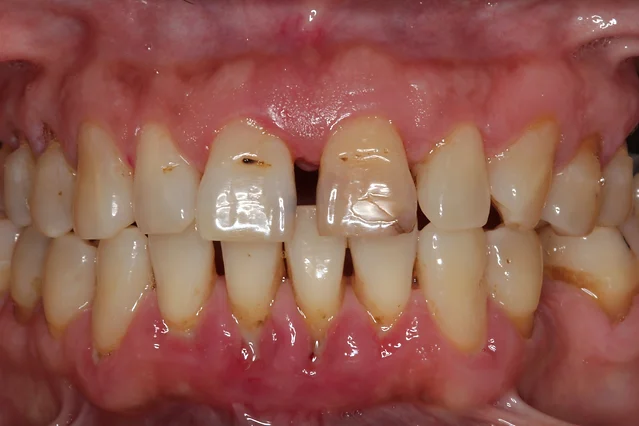 Gum Disease Specialists Periodontal Disease Management Omaha Ne