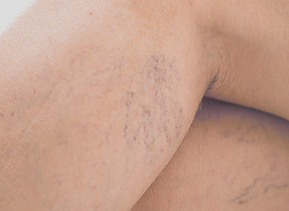 Beenvaatjes, vaatjes, huidbehandeling, LUX Huidkliniek, Huidproblemen, effectief, Eersel, Bergeijk, Huidkliniek