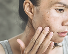 Pigmentproblematiek, Laserbehandeling LUX Huidkliniek, Huidkliniek in Eersel