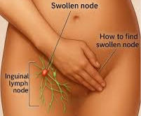 Illustration of a torso with labels indicating a swollen inguinal lymph node. Includes diagrams and text on how to find it.