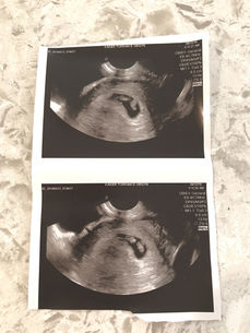Finding Out We Are Having Twins