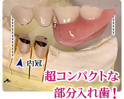 img_denture08.jpg