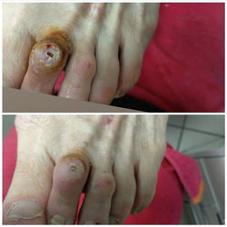 Удаление мозоля на ноге - Подо Центр Дарии Кузьменко