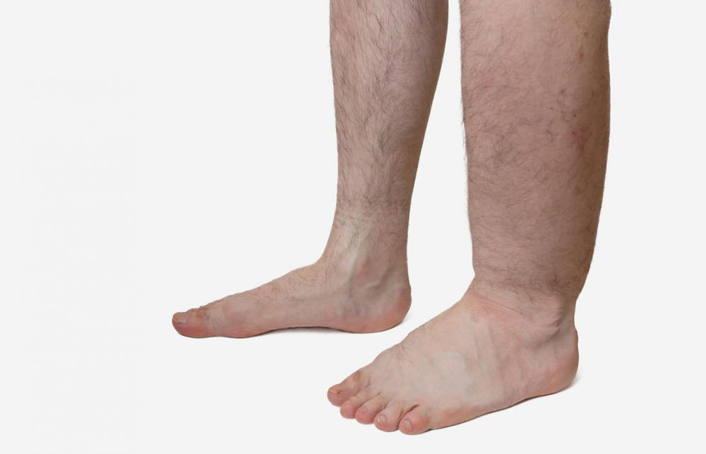 causes-of-leg-ankle-swelling