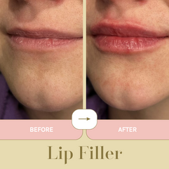 Lip Filler Before & After