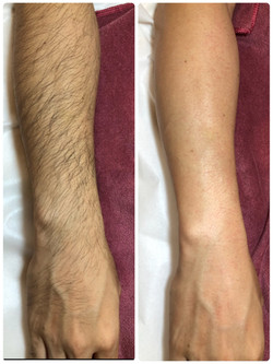 メンズ脱毛 松阪市のエステサロン 押越 女性専科 男性専科でお待ち致しております 脱毛 ヒゲ脱毛 またダイエットもお任せ下さい