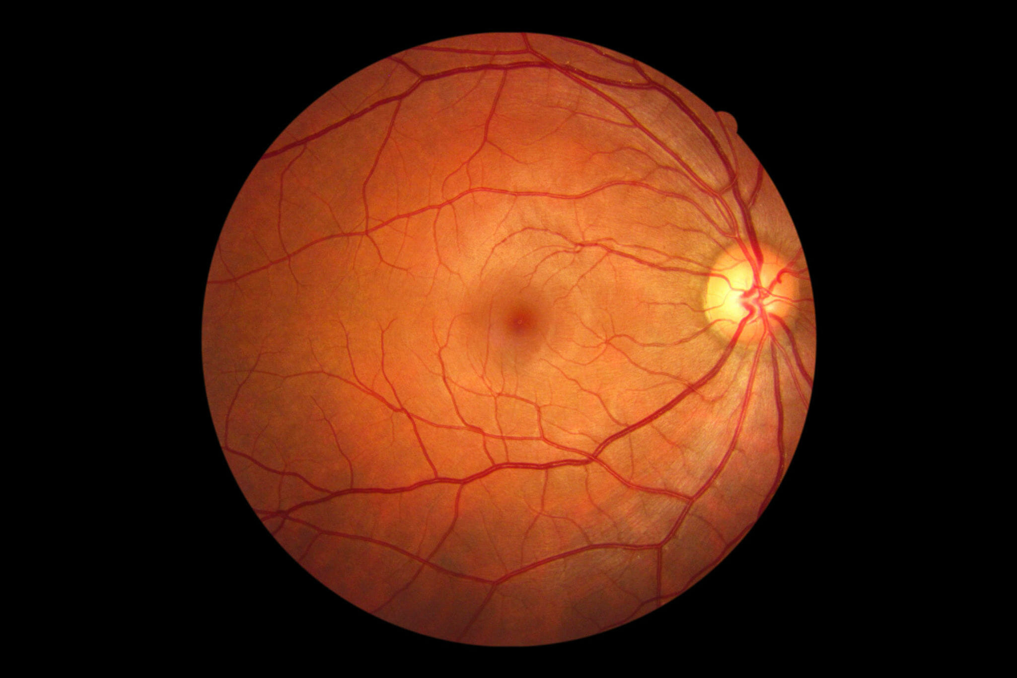 Retina Tuition