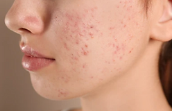 What is the difference between Acne and Fungal Acne?