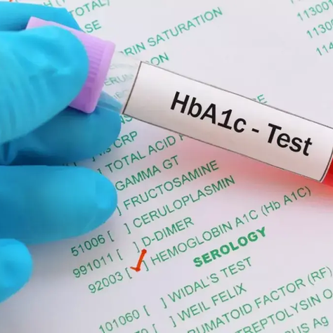 A gloved hand holds a blood sample tube labeled “HbA1c - Test” over a laboratory test form, representing A1C blood sugar testing and diabetes screening.