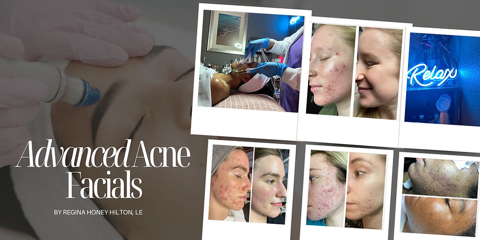 acne-facials-st-louis-mo.jpg