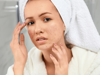 what works for acne