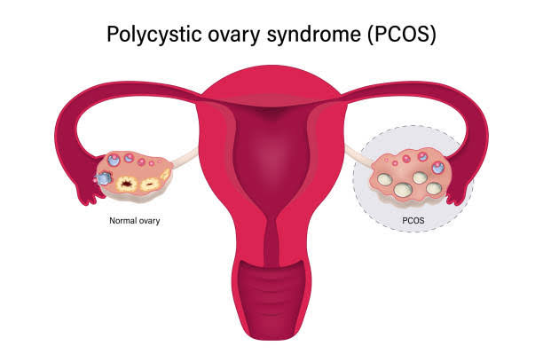 Understanding PCOS: What You Need to Know