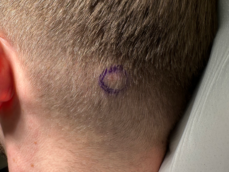 Tired of That Annoying Lump? Quick, Affordable Cyst and Lump Removal Without the Wait