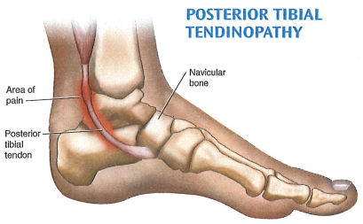 Posterior tibial tendonitis and tendinopathy: causes, symptoms