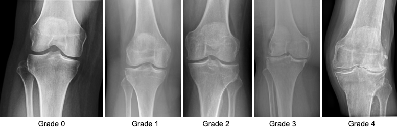 Kellgren and Lawrence Grade for Osteoarthritis
