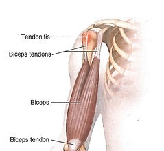 Biceps tendinopathy.jpg