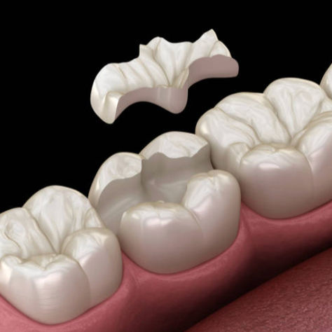 What to Expect After a Dental Filling