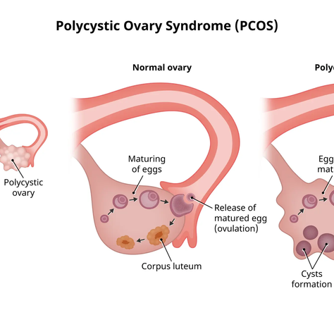 Mengenal PCOS Pada Remaja Wanita