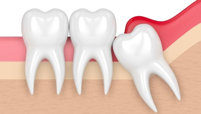 Treatment of Worn Down Dentition & Collapse of Bite 