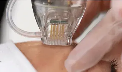 Dermatologische behandeling met microneedling en druppel, Asli Brows Beauty