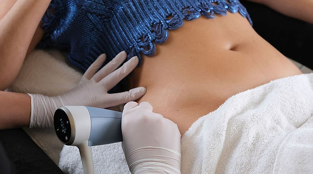 striae-rf-microneedling-behandeling.jpg