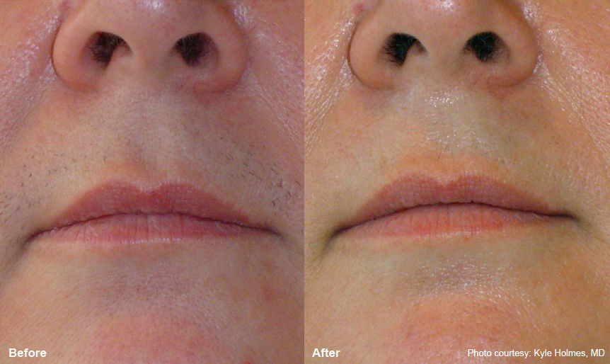 upper_lip_1