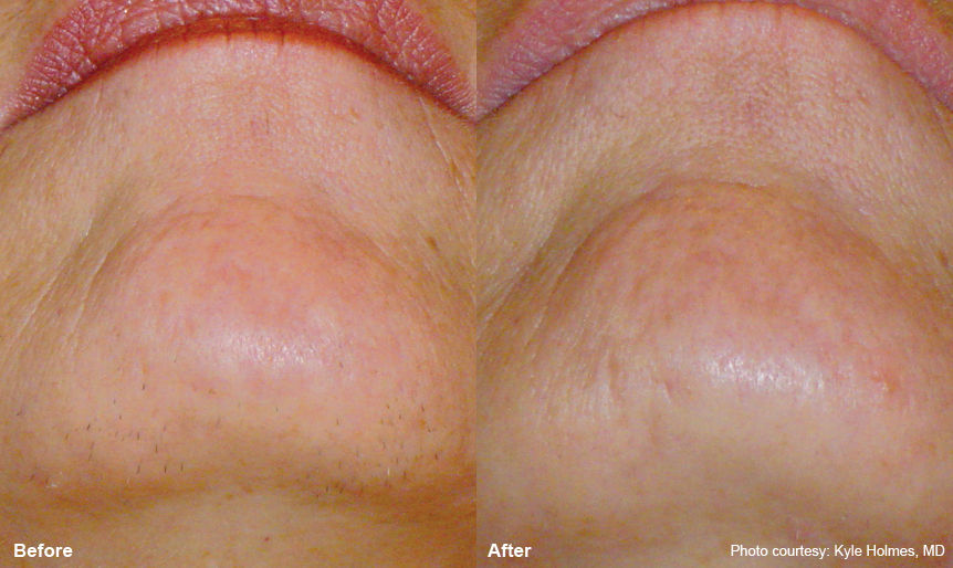 chin_1