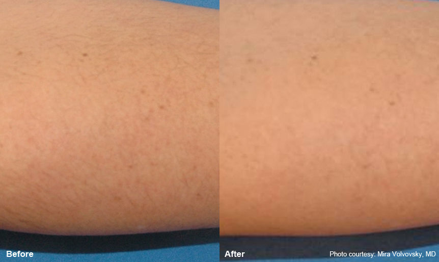 arm_1