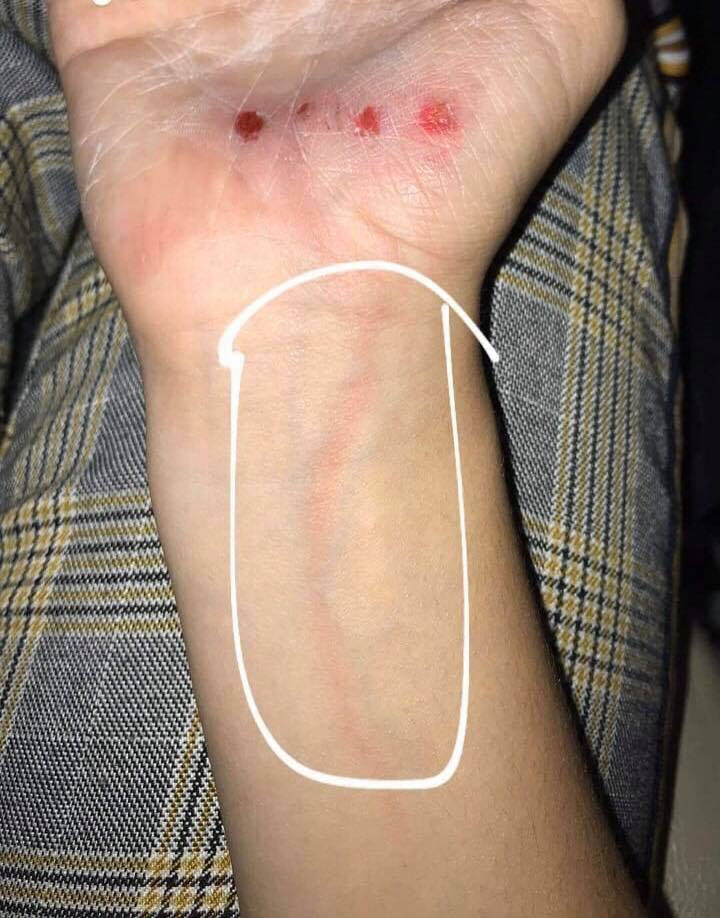Infection système lymphatique, lymphangite