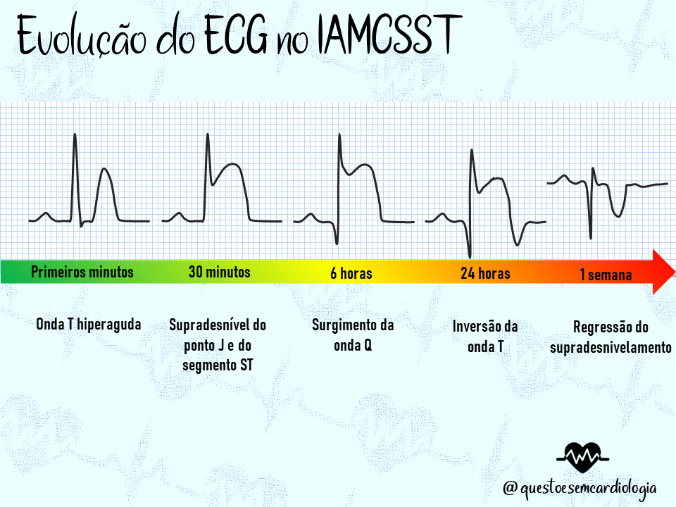 Como acontece a evolução eletrocardiográfica do supra de ST? Como acontece a evolução eletrocardiográfica do supra de ST?