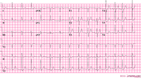 Caso ECG 2: paciente assintomático em risco cirúrgico