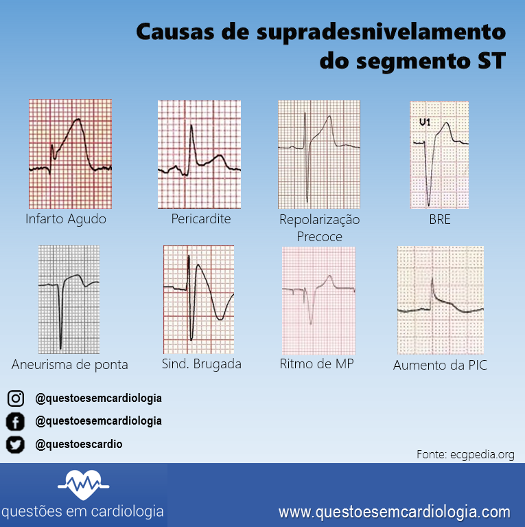 Causas de supradesnivelamento do segmento ST Causas de supradesnivelamento do segmento ST