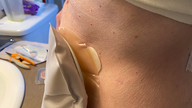 Body Image and Disease