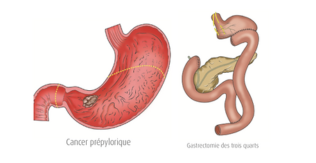 Cancer Gastrique