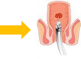 Polypes du Rectum